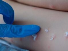 REPORTAN EL 1° CASO SOSPECHOSO DE VIRUELA DEL MONO EN EL PAÍS.