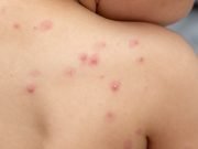 Viruela símica: se confirmaron dos nuevos casos en la provincia.