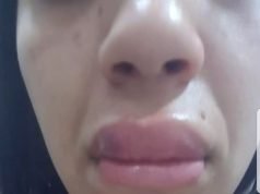 PASA EN REDES: UNA MUJER FUE AGREDIDA EN UNA ESTÉTICA TRAS RECLAMAR QUE SE DEFORMARON SUS LABIOS LUEGO DE UN TRATAMIENTO.