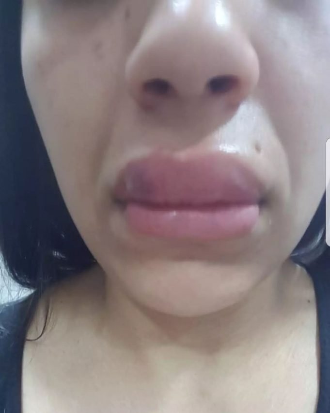 PASA EN REDES: UNA MUJER FUE AGREDIDA EN UNA ESTÉTICA TRAS RECLAMAR QUE SE DEFORMARON SUS LABIOS LUEGO DE UN TRATAMIENTO.
