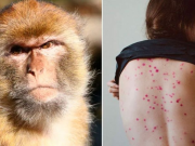 FINALIZÓ LA EMERGENCIA SANITARIA MUNDIAL POR LA VIRUELA DEL MONO.