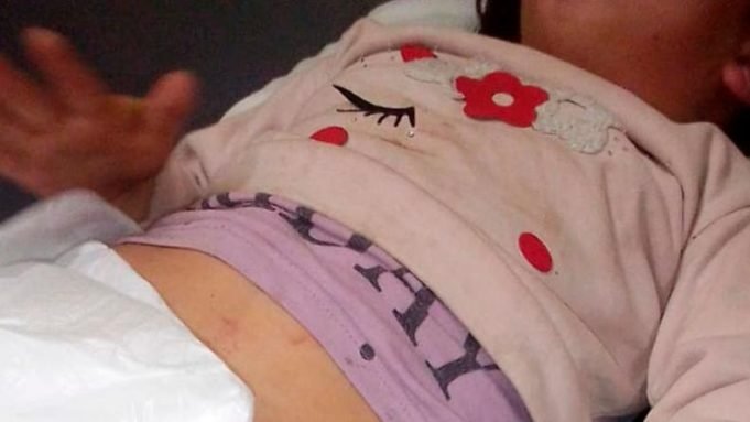 UN PERRO ATACÓ Y ARRASTRÓ A UNA NENA DE 5 AÑOS EN UNQUILLO.