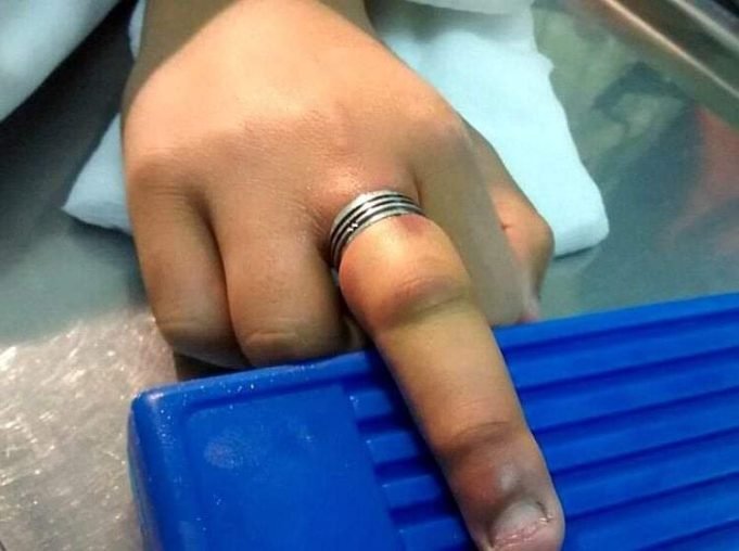 JESÚS MARÍA: ASISTIERON A UNA JOVEN QUE SE LE ATASCÓ UN ANILLO EN EL DEDO.