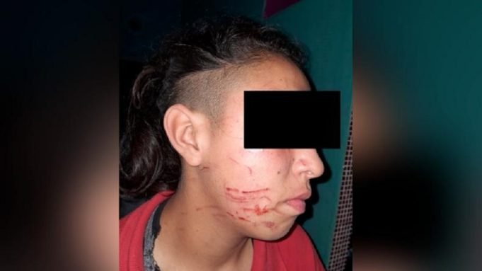 JUAREZ CELMAN: CHICAS ATACARON A GOLPES A UNA ADOLESCENTE Y CORTARON SU CARA CON UNA TRINCHETA.