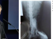 AUDITARÁN MÁS DE 1MILLÓN DE PENSIONES POR DISCAPACIDAD. HAY RADIOGRAFÍAS REPETIDAS Y HASTA LA DE UN PERRO.